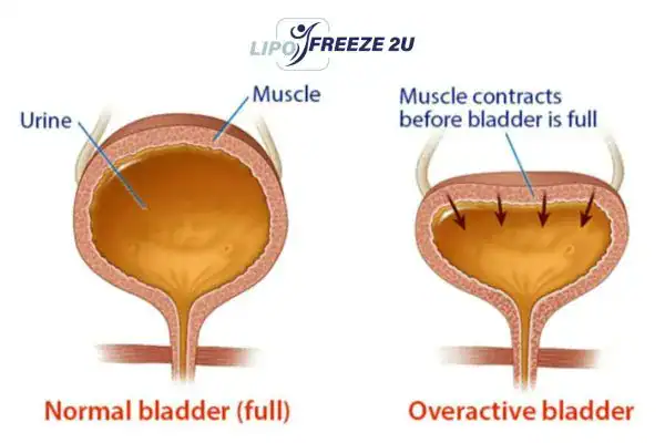diagram of overactive bladder treatment Chorleywood