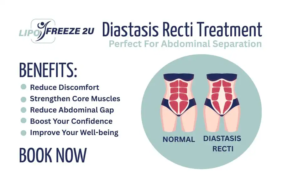 Benefits of body toning treatment Chorleywood for Diastasis recti