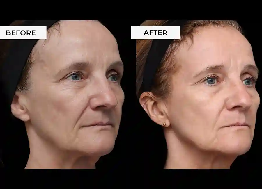 How Many RF Microneedling Sessions Will You Need to See a Difference Chorleywood?