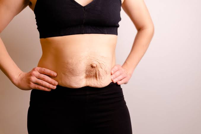 Is Surgery Really the Only Way to Repair Diastasis Recti Chorleywood?